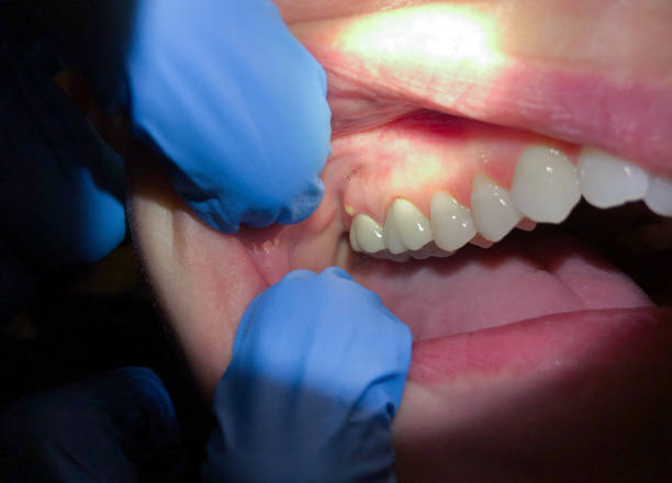 Best Emergency Dental Care for Broken or Chipped Teeth in Amityville, NY